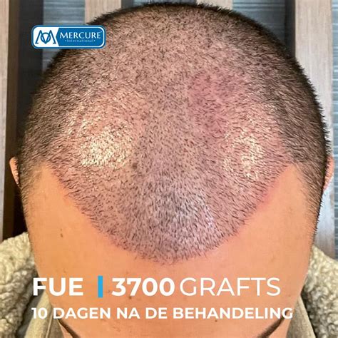 De Innovaties Achter Saffier FUE Haartransplantatie