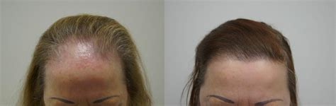 Haartransplantatie Bij Vrouwen: Speciale Overwegingen