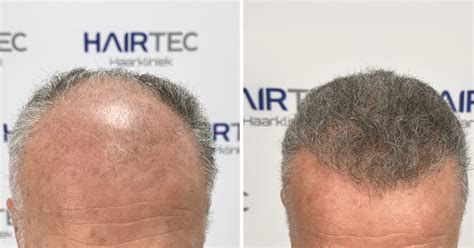 Haartransplantatie DHI: Behandelingen En Herstel