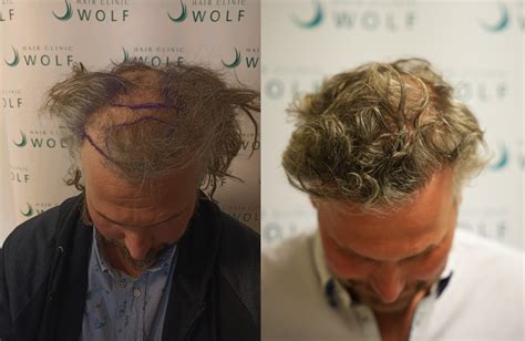 Haartransplantatie DHI Voor Mannen En Vrouwen