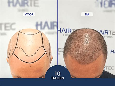 Haartransplantatie Voor En Na: Patiëntenervaringen