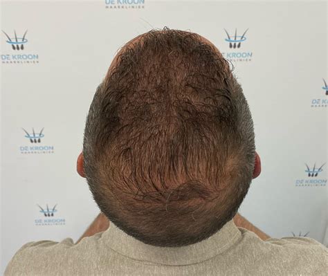 Herstelproces Na Een Haartransplantatie Behandeling