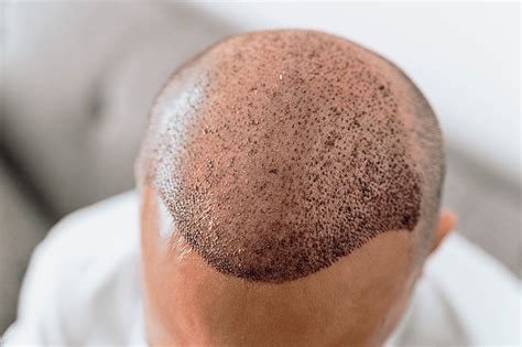 Wat Je Moet Weten Over Haartransplantatie Fase